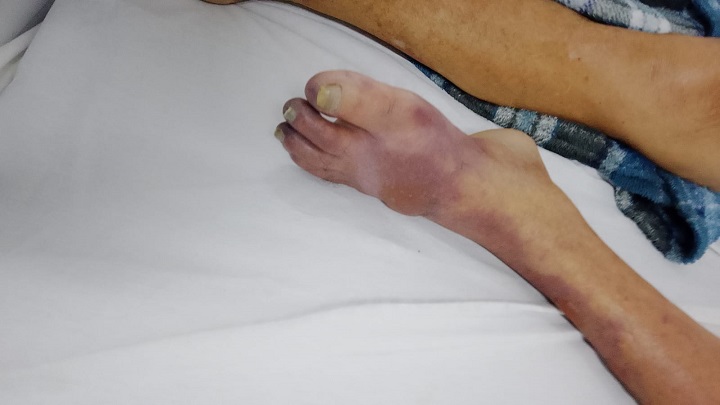 Jacobina: família denuncia demora na regulação e teme amputação de idoso internado na UPA